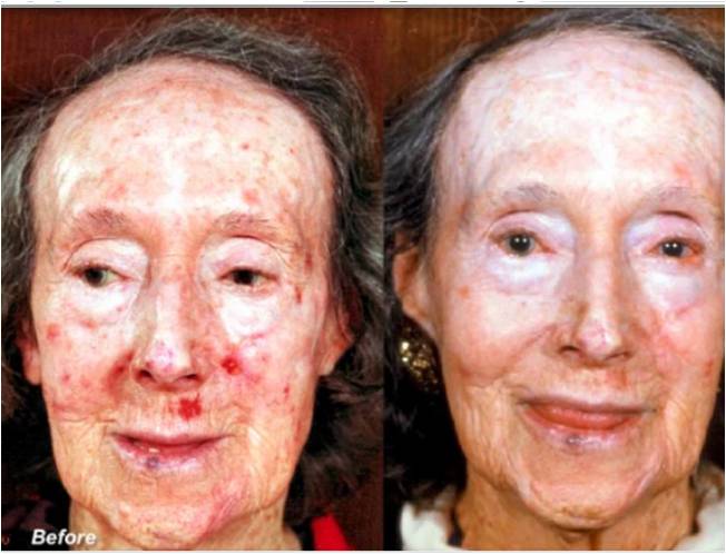 lactic acid peel