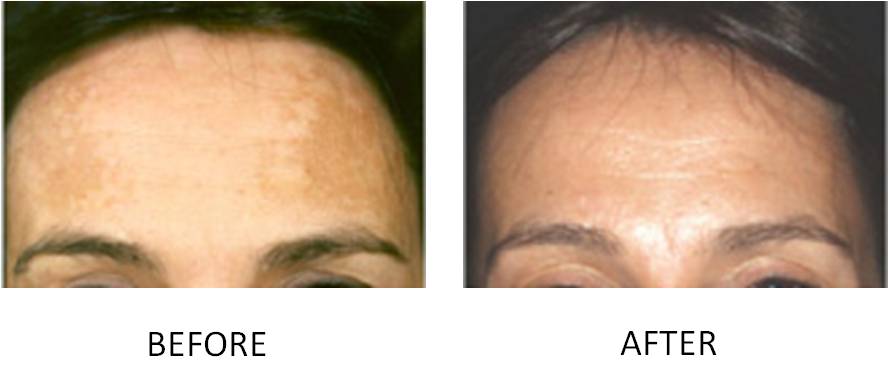 how-do-i-get-rid-of-pregnancy-pigmentation-marks-on-my-face-myskinandco